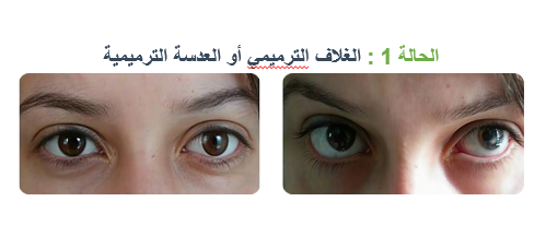 الحالة 1 - تركيب العدسة الترميمية