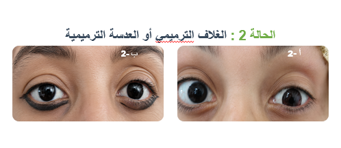 الحالة 2 - تركيب الغلاف الترميمي