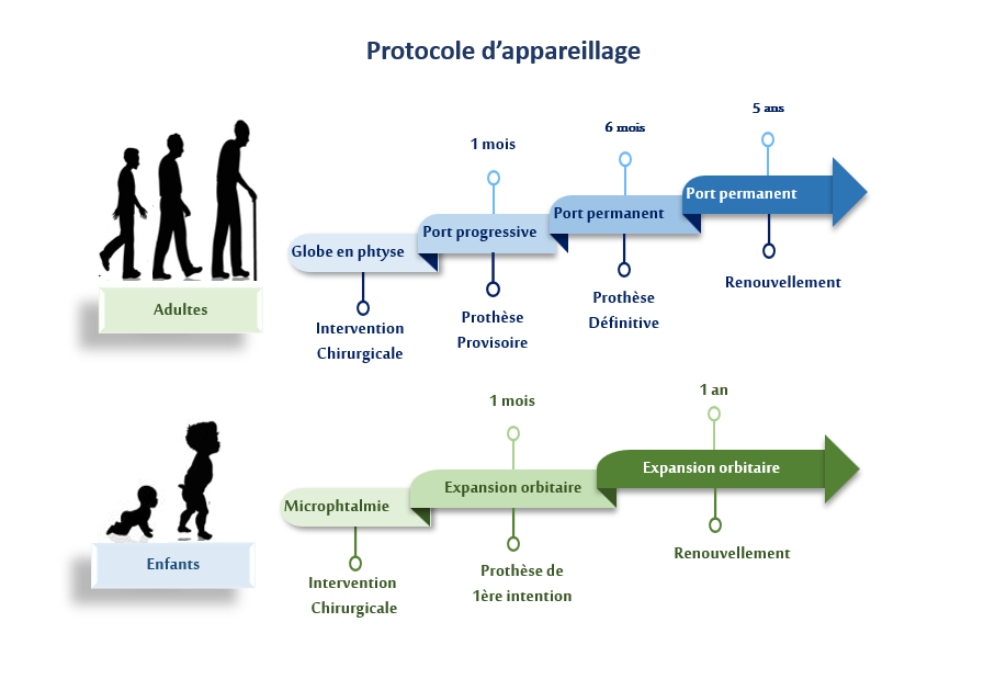 Schéma illustrant le protocole de pose de la prothèse oculaire