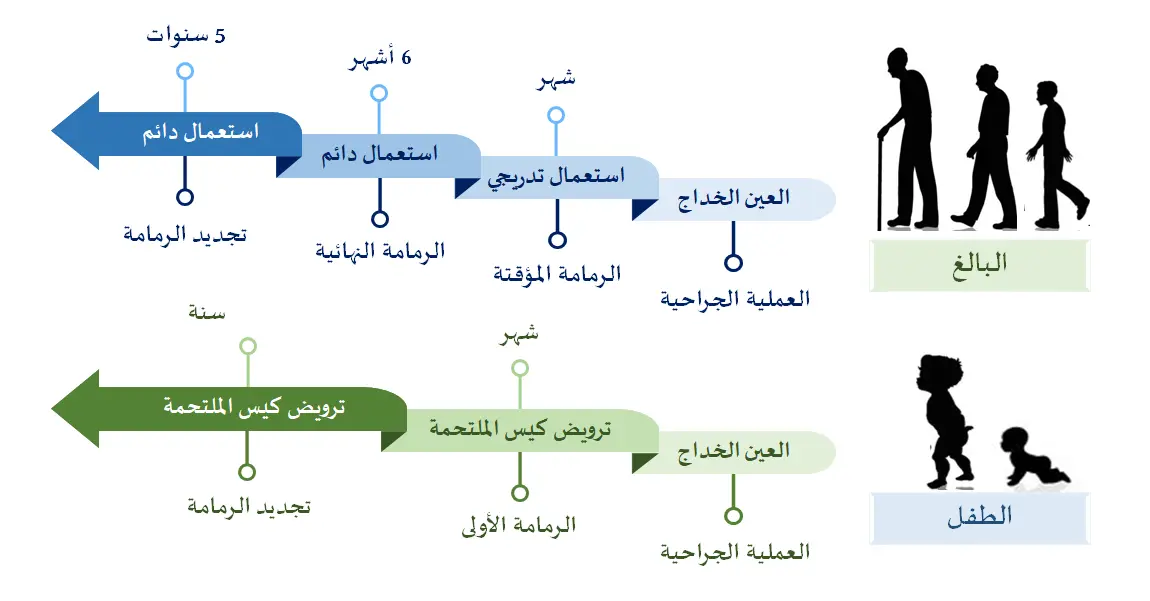 رسم توضيحي لنظام تركيب رمامة العين